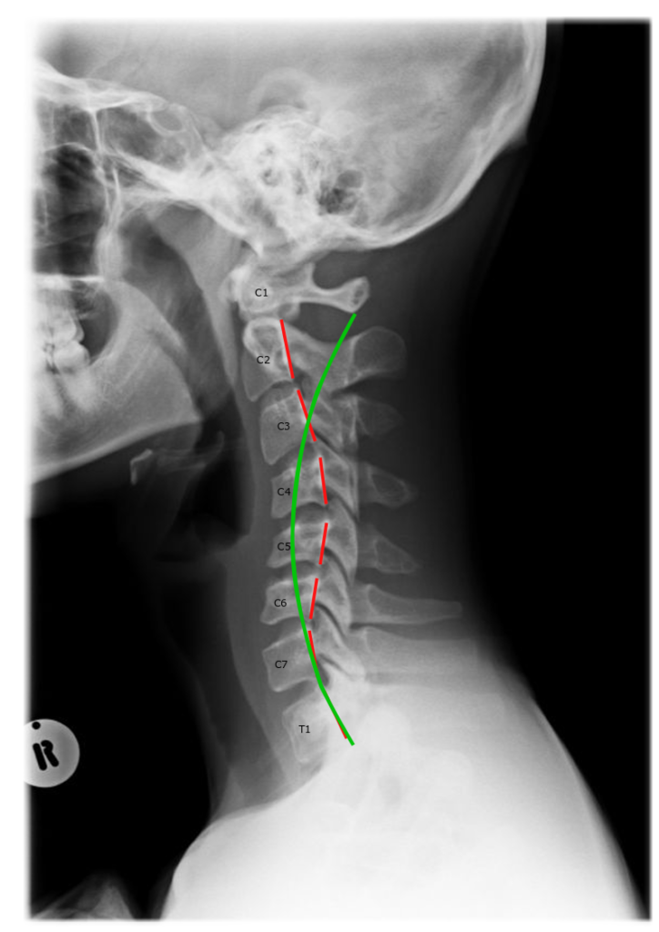 When your migraine actually comes from your neck