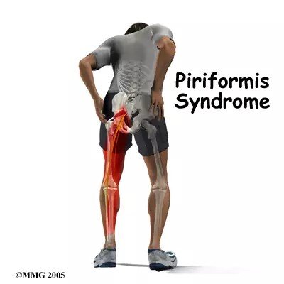 Person with piriformis syndrome pain in the hip and buttock