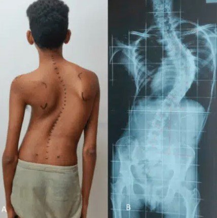 Child undergoing a scoliosis spine screening