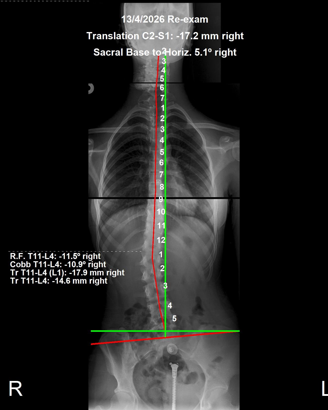After scoliosis CBP X-ray — Cobb angle 10.9 degrees right at 3 months, April 2026