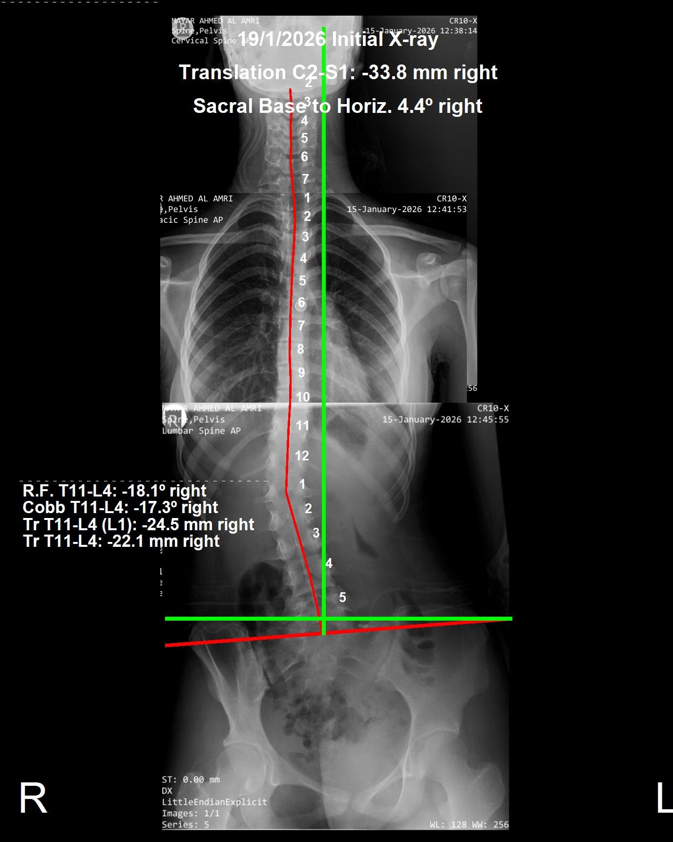 Before scoliosis CBP X-ray — Cobb angle 17.3 degrees right, January 2026