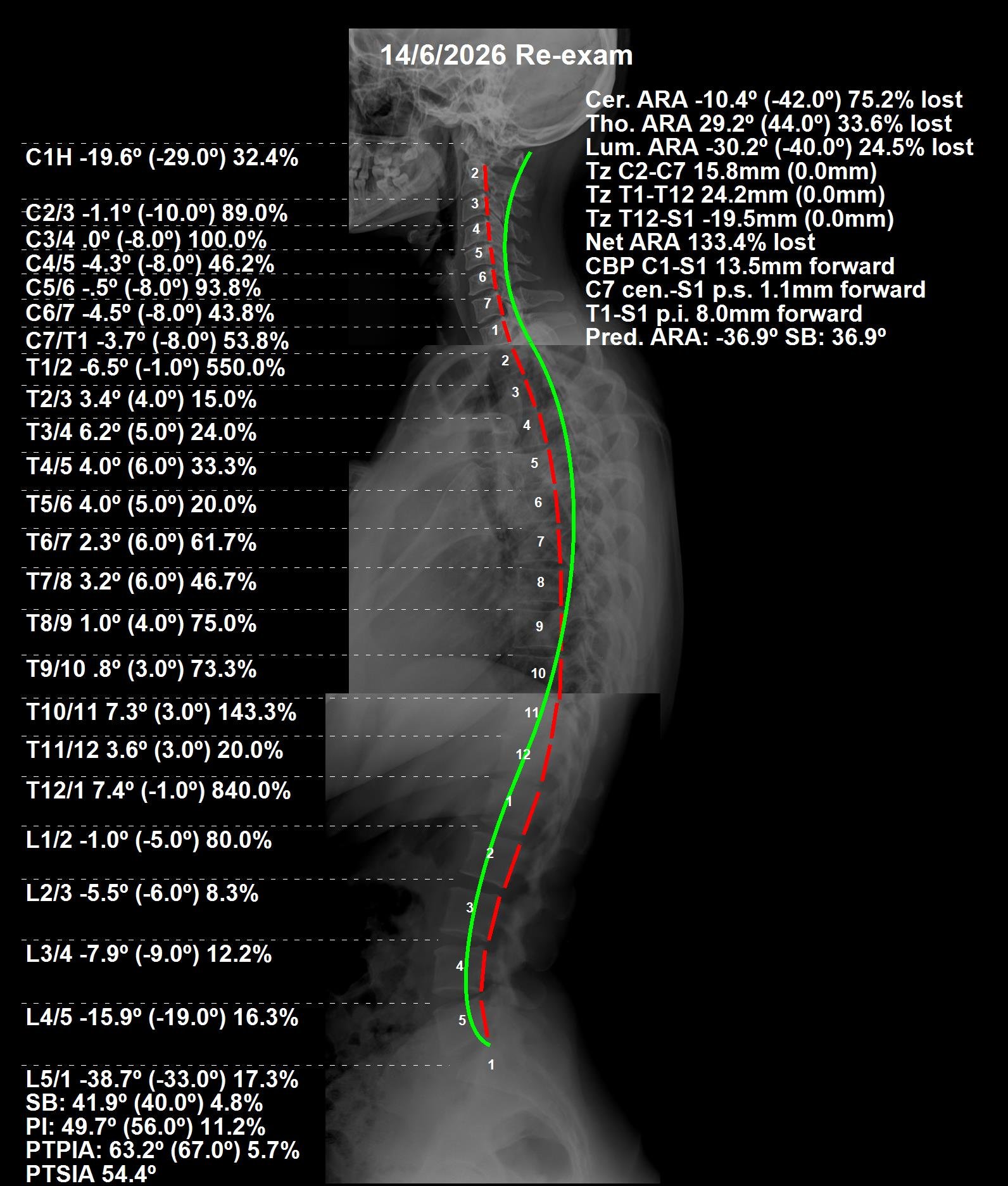 After CBP full spine X-ray — global sagittal balance restored at 4 months, Jun 2026
