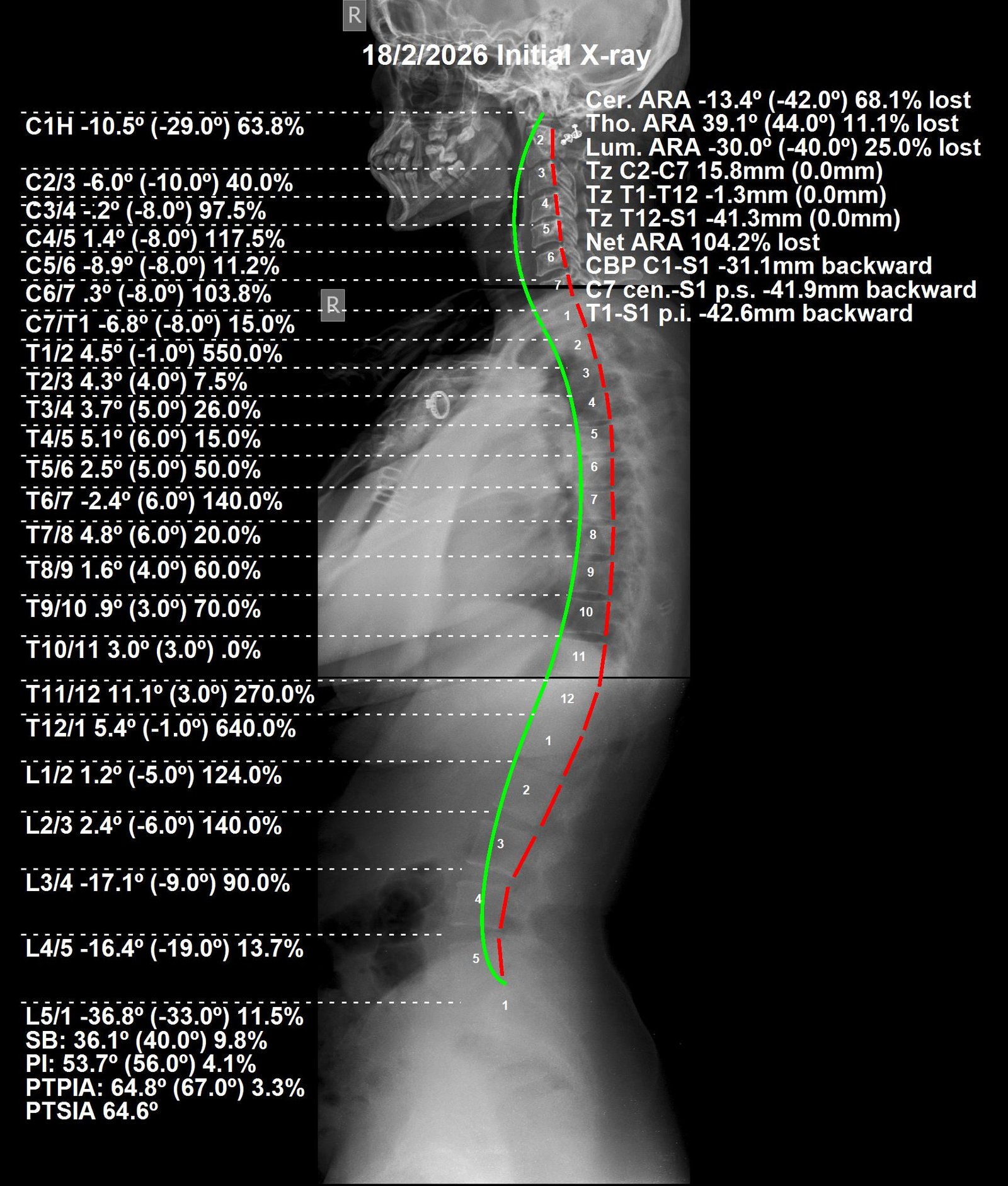 Before CBP full spine X-ray — radicular neck and lower back pain, Feb 2026
