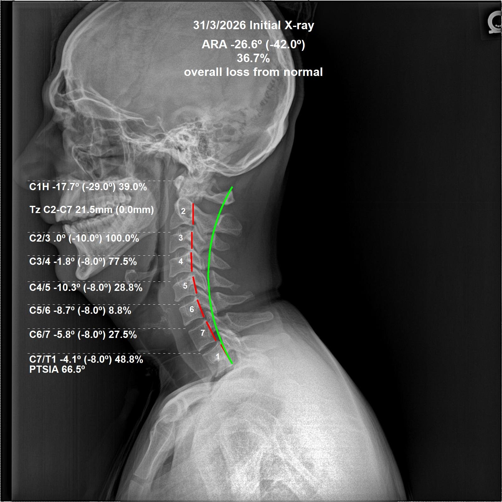 Before cervical CBP X-ray — neck and upper back pain, March 2026
