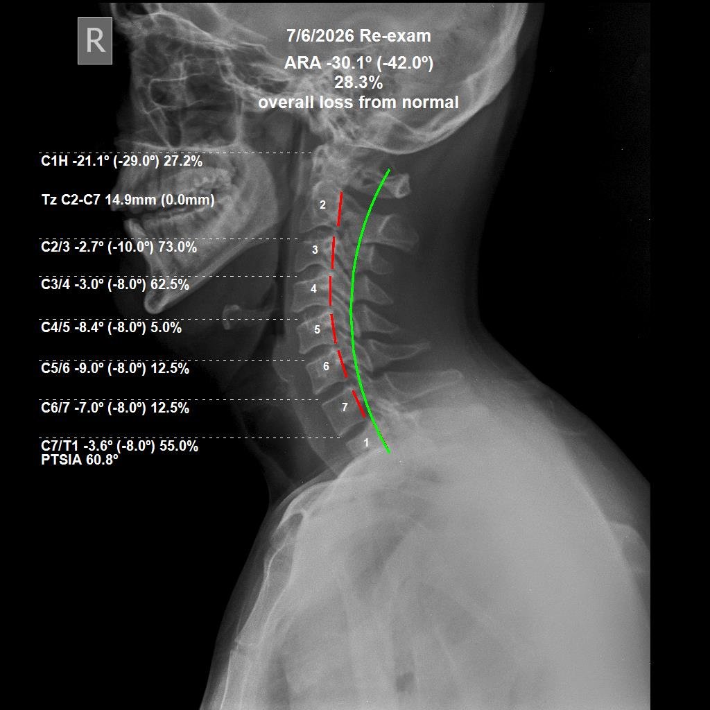 After cervical CBP X-ray — structural correction at 3 months, June 2026