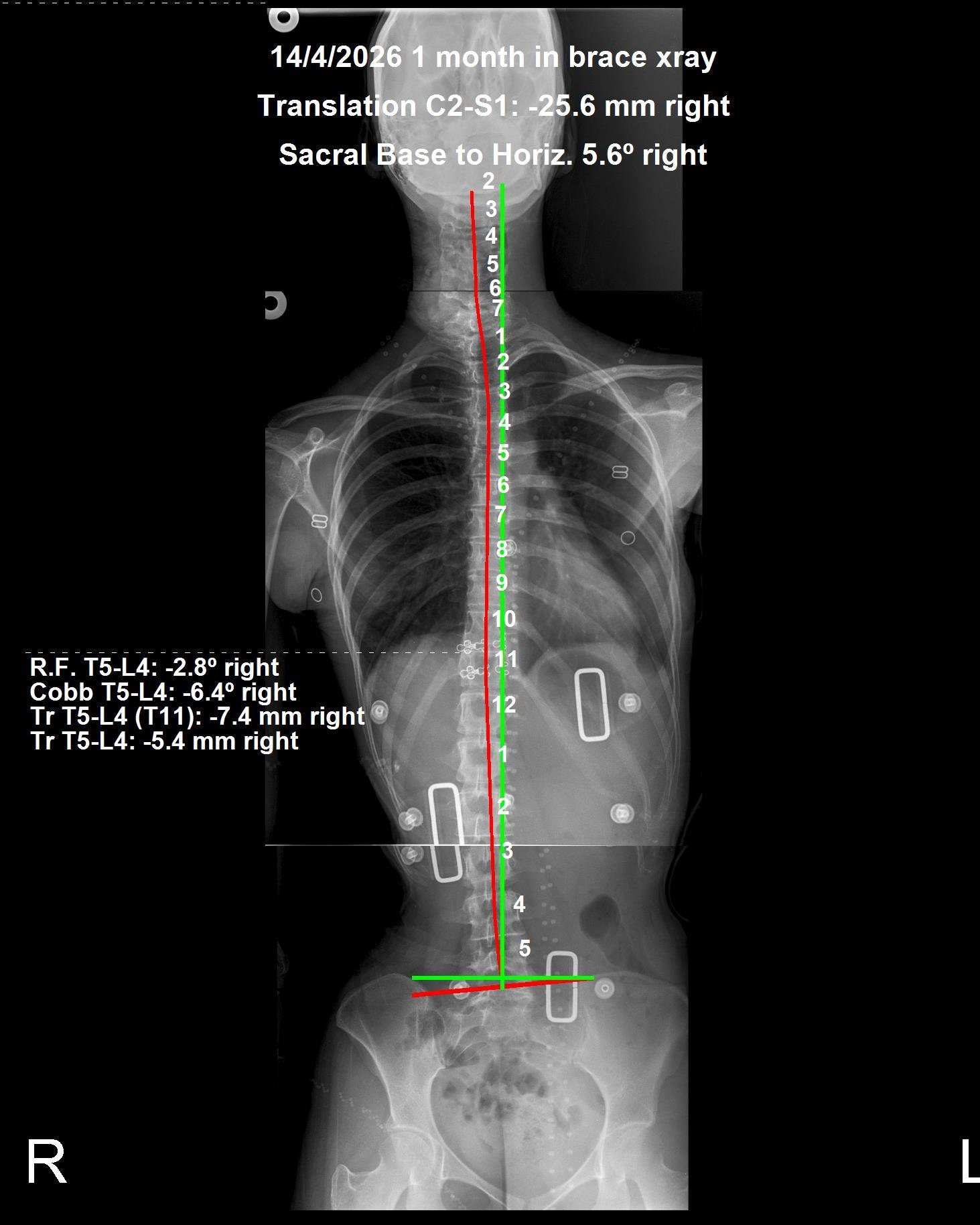 In-brace X-ray — thoracolumbar scoliosis Cobb angle 6.4 degrees at 1 month
