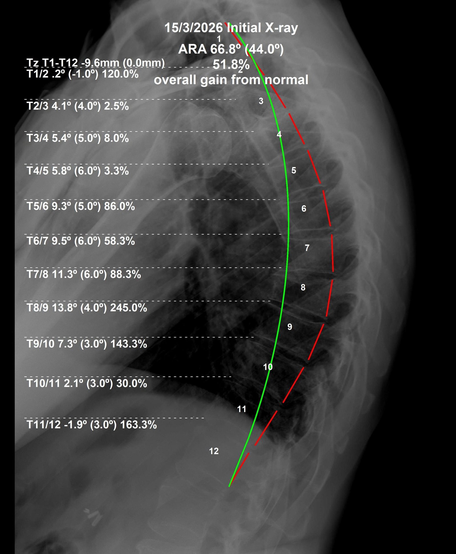Before thoracic CBP X-ray — Scheuermann's kyphosis, March 2026