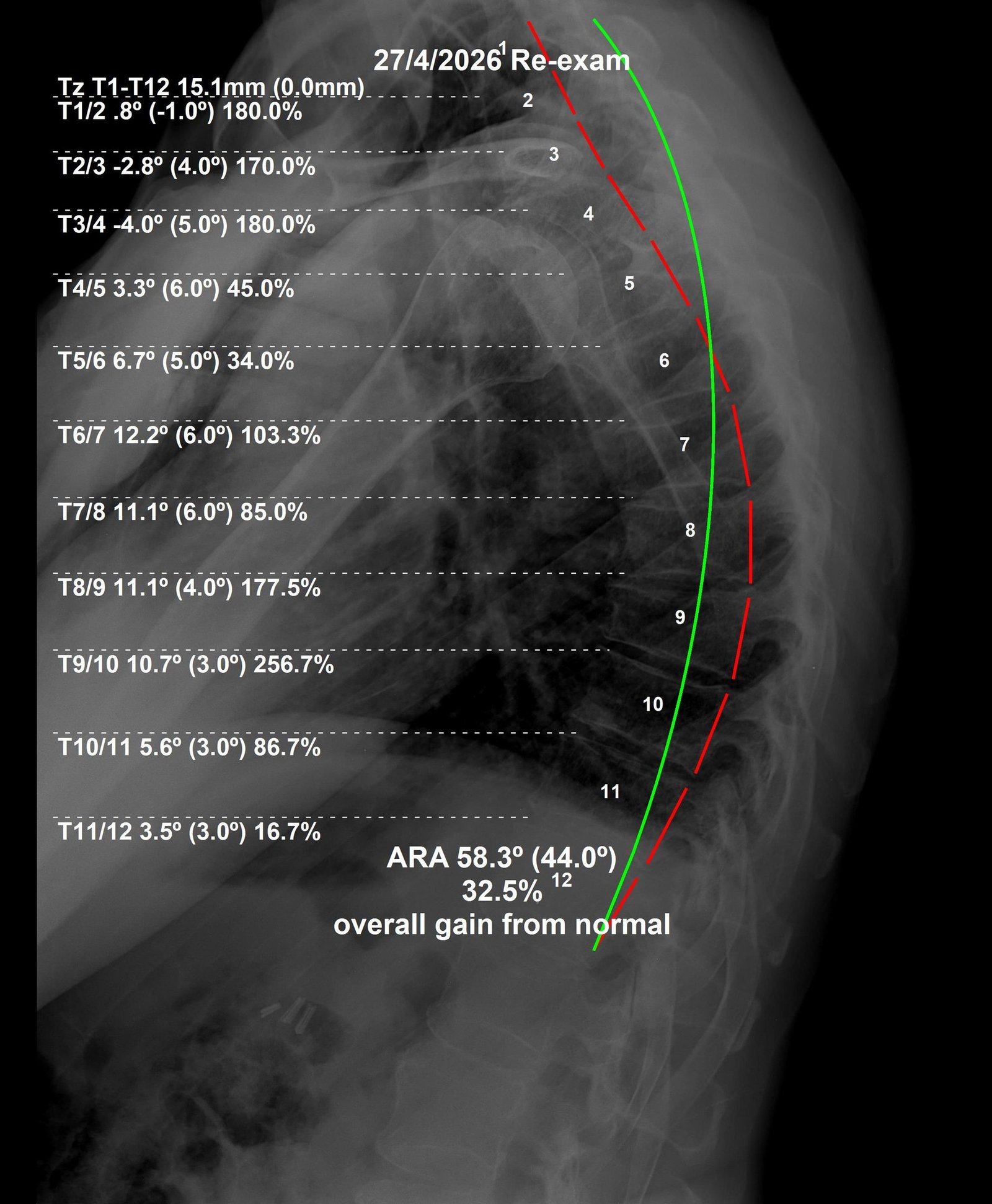 After thoracic CBP X-ray — Scheuermann's kyphosis correction at 2 months, April 2026