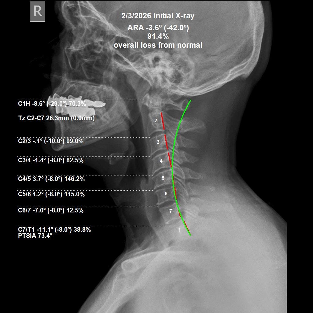 Before cervical CBP X-ray — 91.4% ARA loss from normal, March 2026