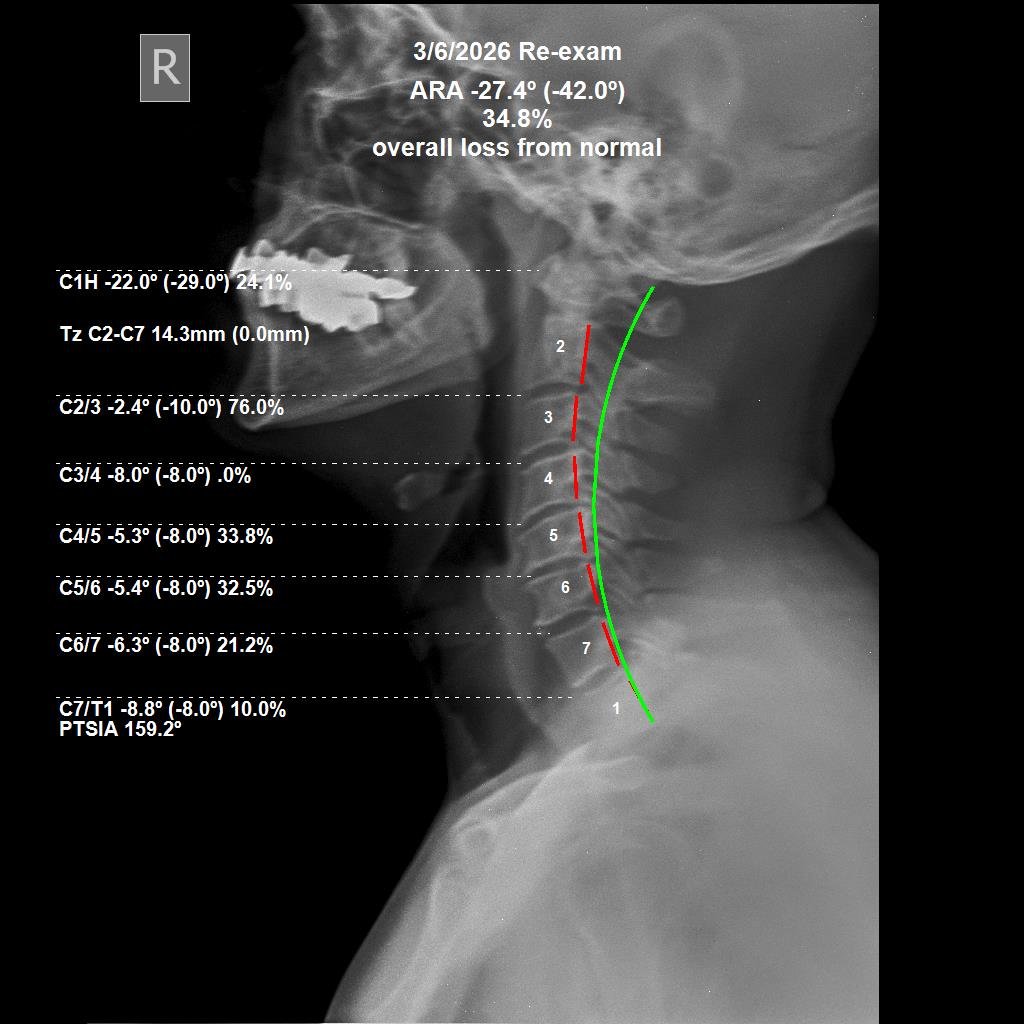 After cervical CBP X-ray — 34.8% ARA loss from normal at 3 months, June 2026