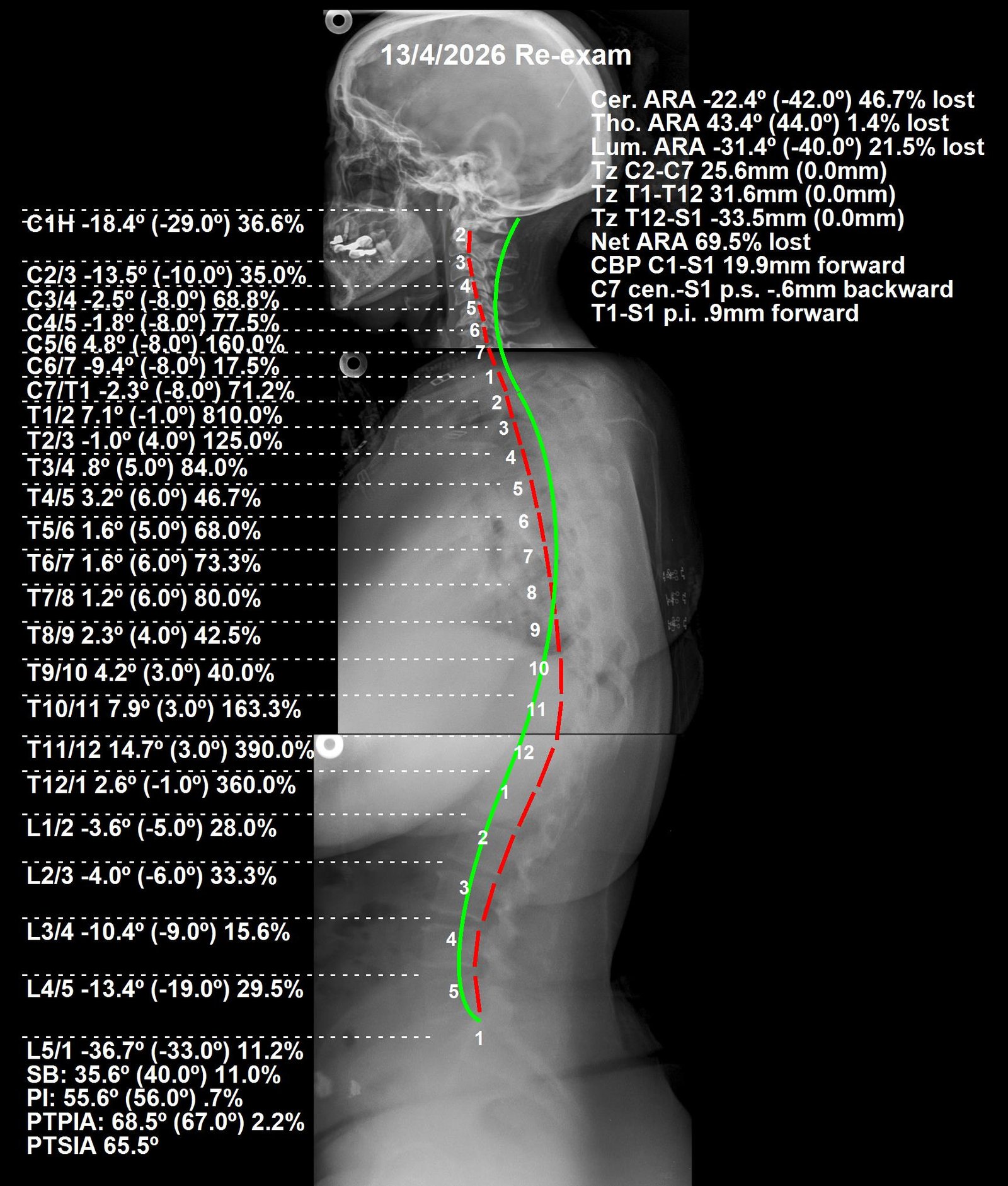 After CBP full spine X-ray — structural correction at 5 months, Apr 2026