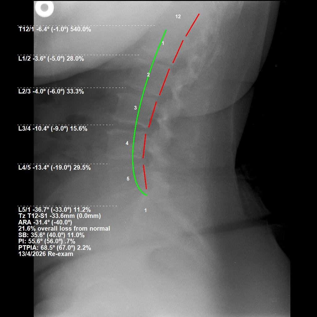 After lumbar CBP X-ray — structural correction at 4 months, Apr 2026