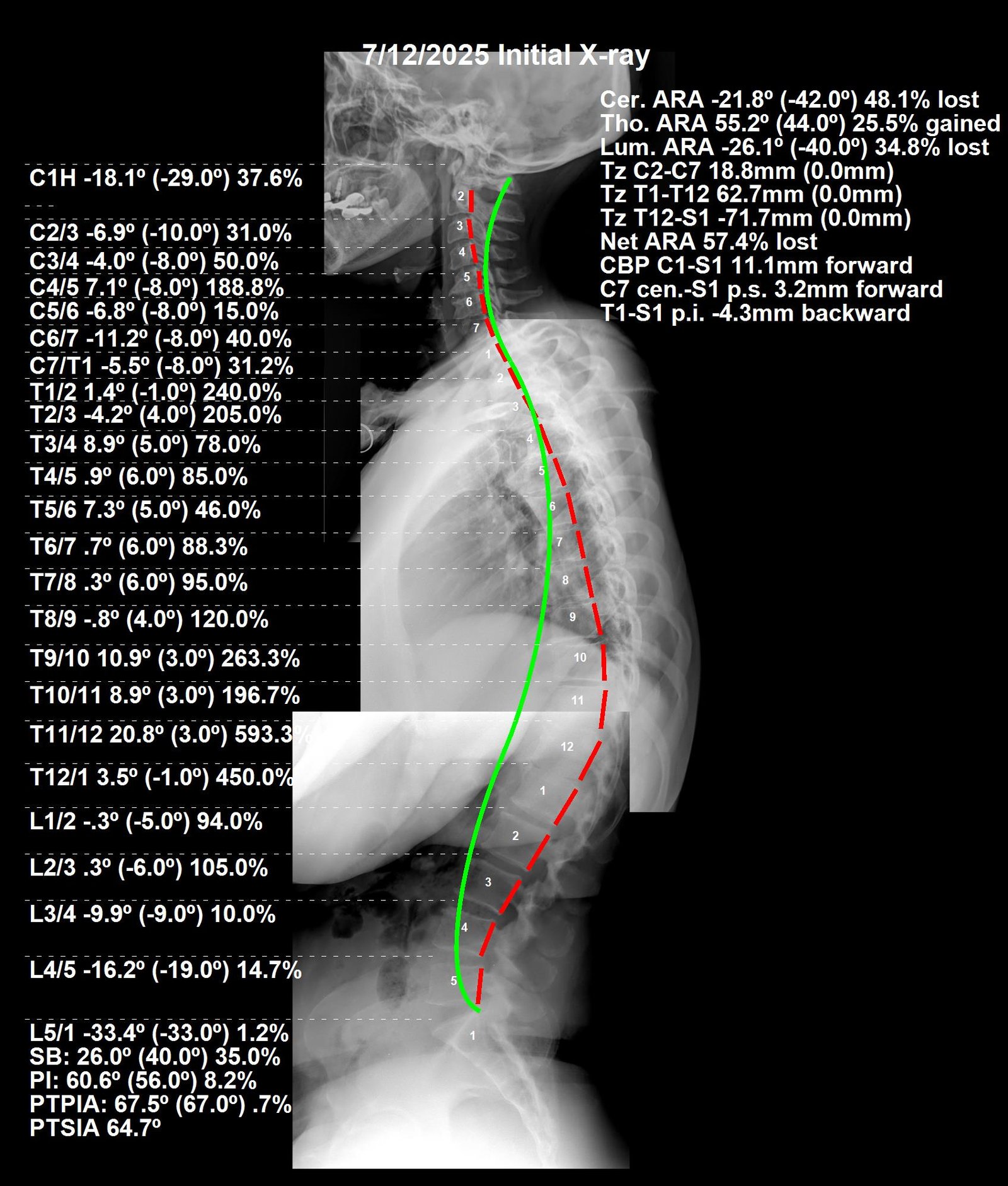 Before CBP full spine X-ray — lower back pain and leg tingling, Dec 2025