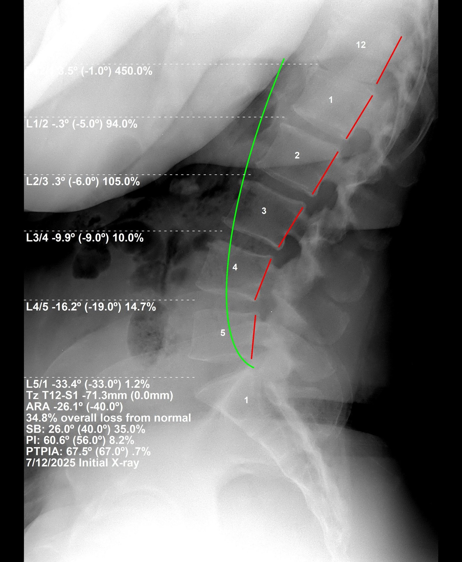 Before lumbar CBP X-ray — leg tingling and numbness, Dec 2025