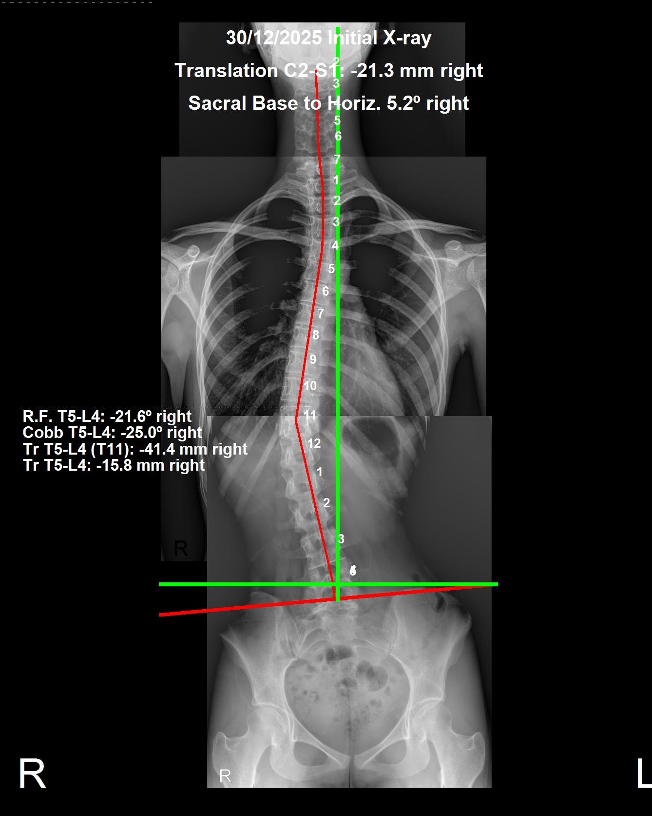 Before and after standing X-ray of scoliosis correction at CBP Precision Spine Center