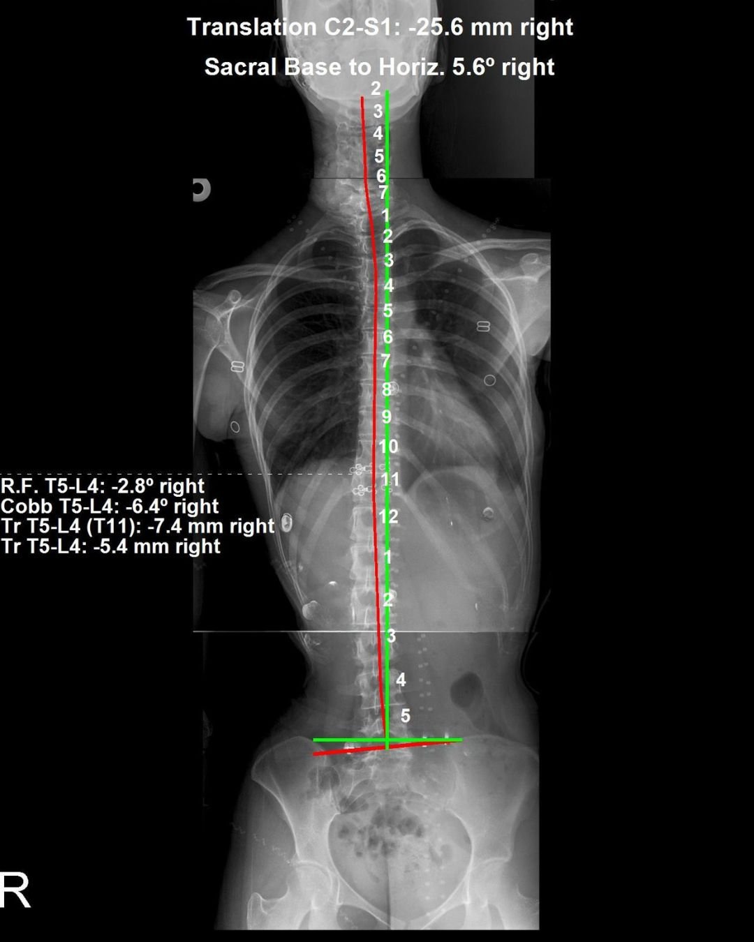 Before and after standing X-ray of scoliosis correction