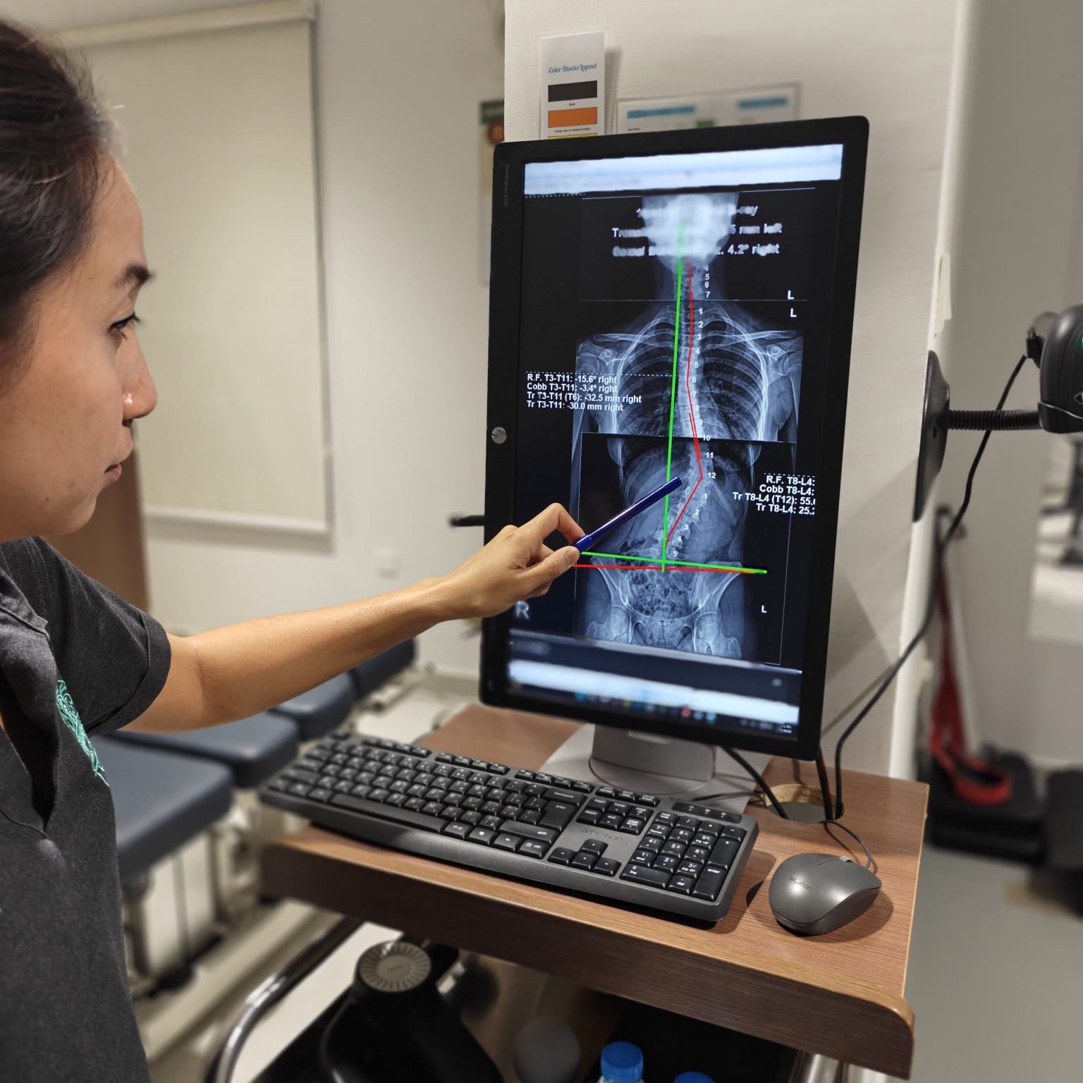 A spine affected by scoliosis