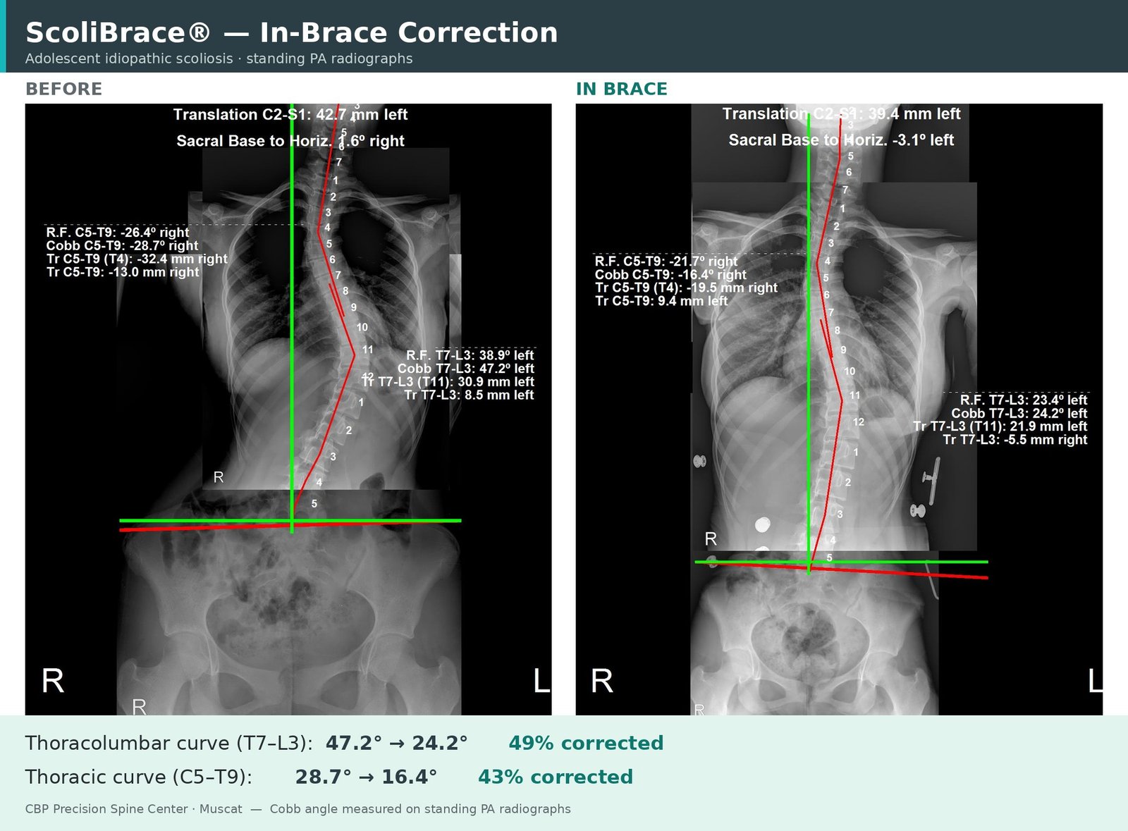 Before and in-brace scoliosis X-rays showing a 49% Cobb angle correction with a custom ScoliBrace at CBP Precision Spine Center in Muscat