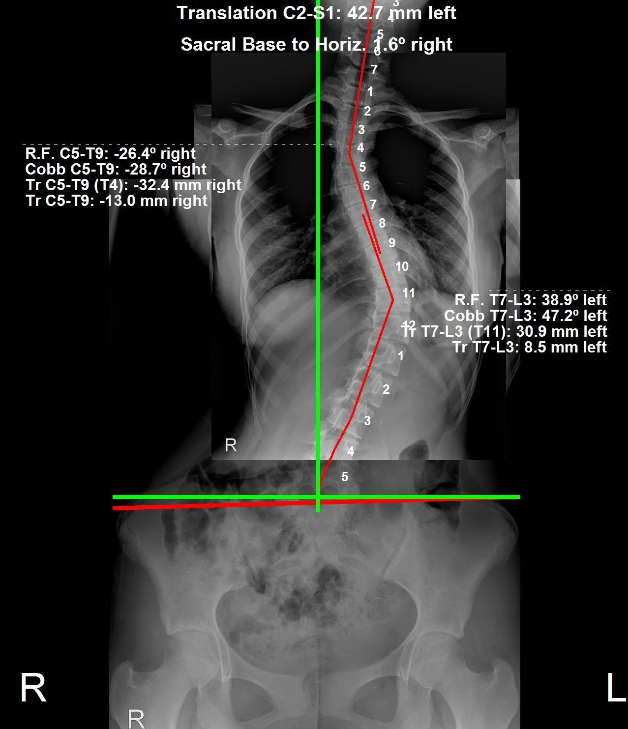 Pre-brace standing X-ray of adolescent thoracolumbar scoliosis, 47 degree Cobb angle, before ScoliBrace treatment at CBP Precision Spine Center Muscat