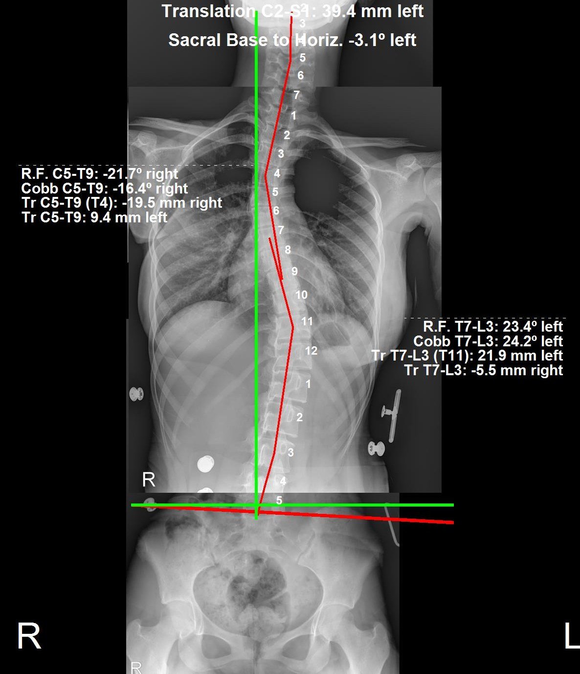 In-brace standing X-ray showing the thoracolumbar scoliosis curve corrected to 24 degrees, a 49 percent in-brace correction in a custom ScoliBrace at CBP Precision Spine Center Muscat