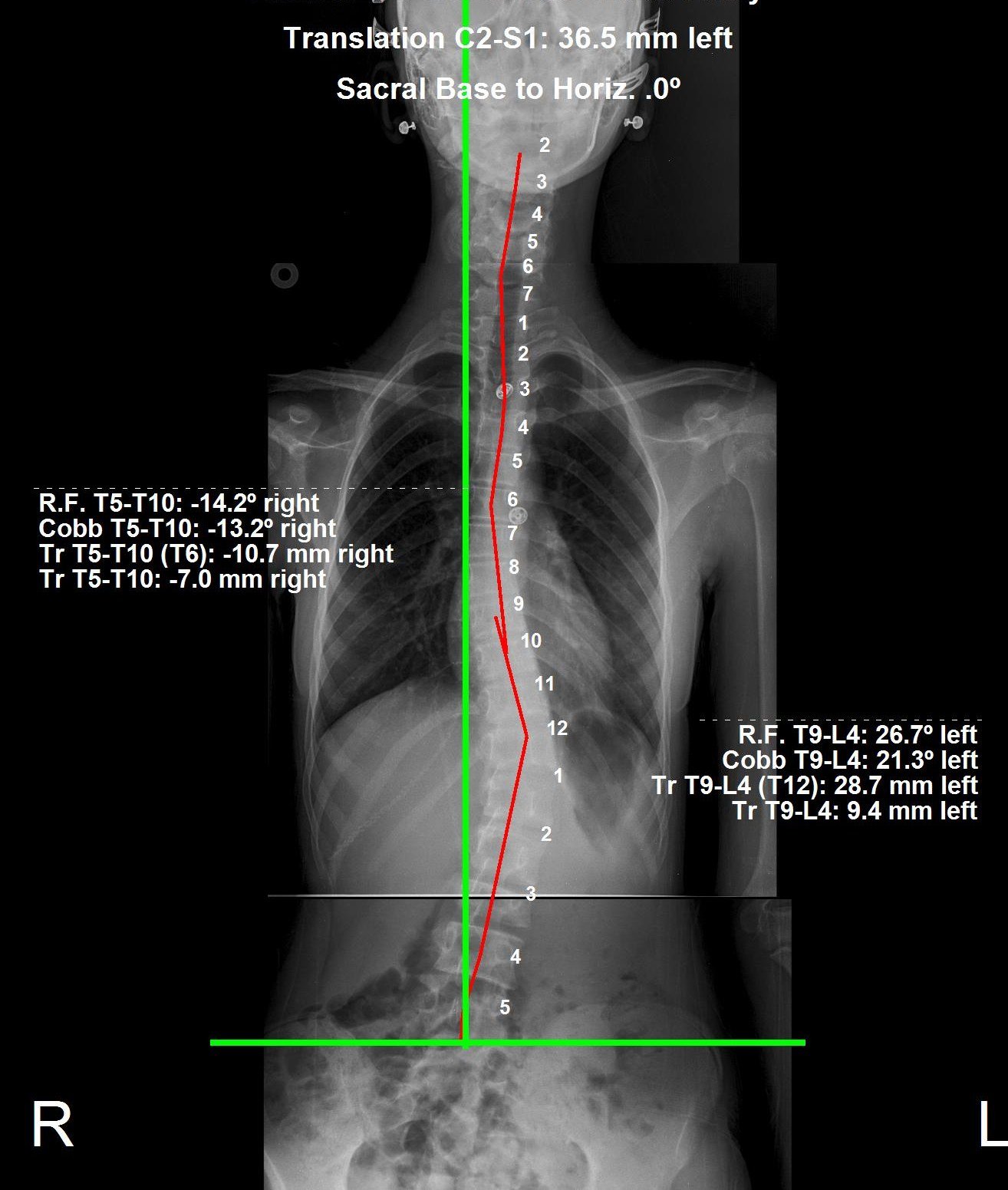 Out-of-brace standing X-ray after 3 months showing the thoracolumbar scoliosis curve reduced to 21.3 degrees following ScoliBrace treatment at CBP Precision Spine Center Muscat
