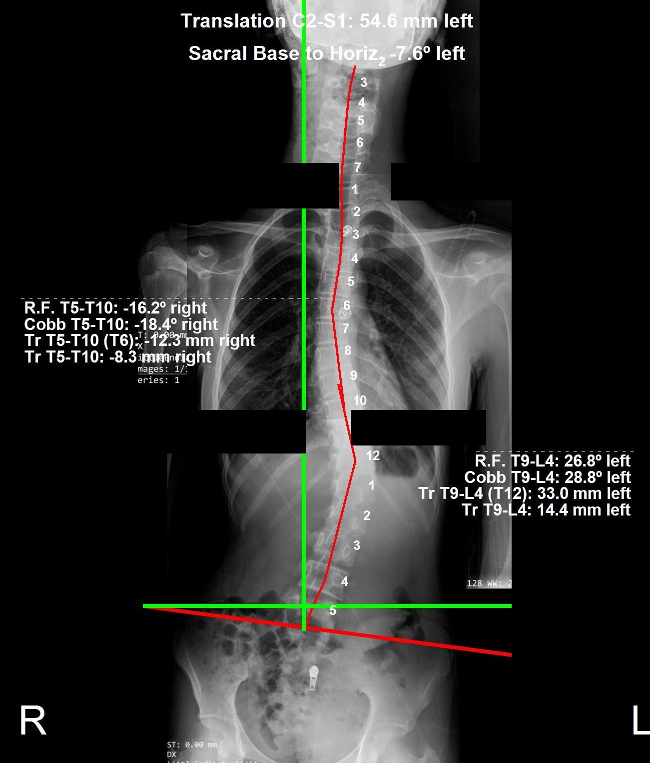 Pre-treatment standing X-ray of adolescent thoracolumbar scoliosis, 28.8 degree Cobb angle, before ScoliBrace treatment at CBP Precision Spine Center Muscat