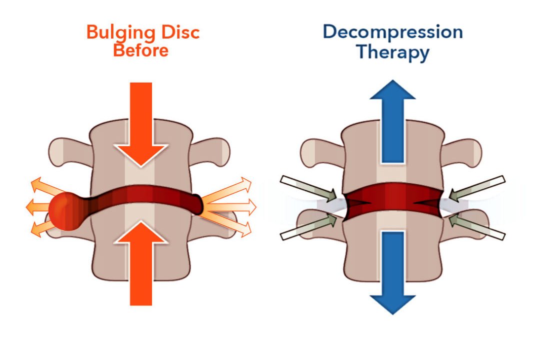 How decompression creates space at the disc